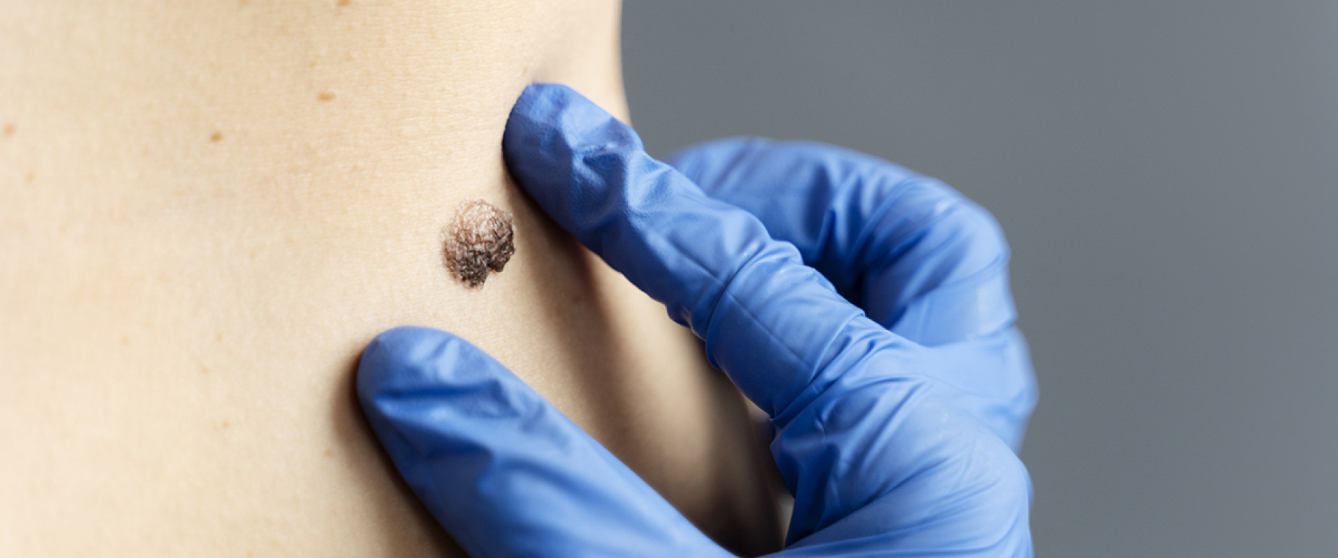 Удаление новообразований кожи (папилломы, кератомы)